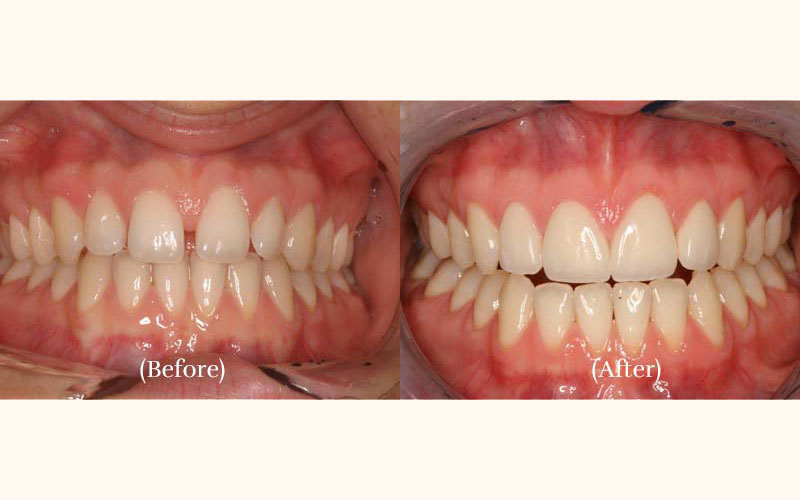 Before & After Minimal Prep Veneers