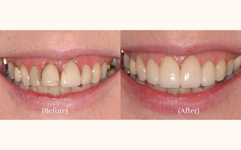 4 Veneers & Laser Tissue Contouring