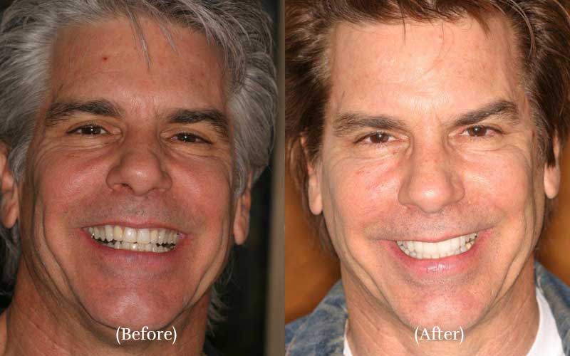 Before After Vaneers