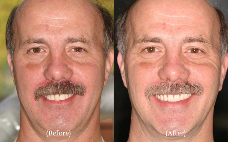 Full smile makeover