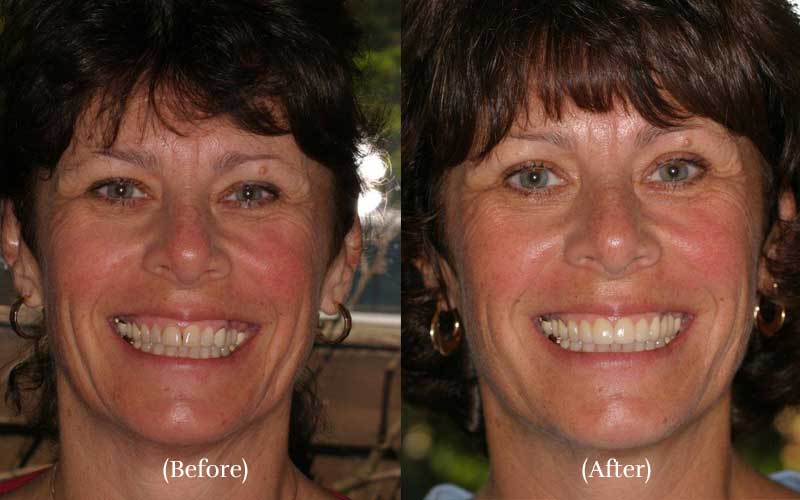 Porcelain veneers smile