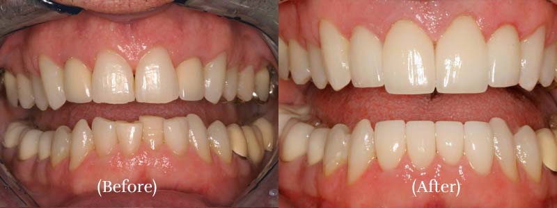 Upper & lower veneers upper & lower veneers