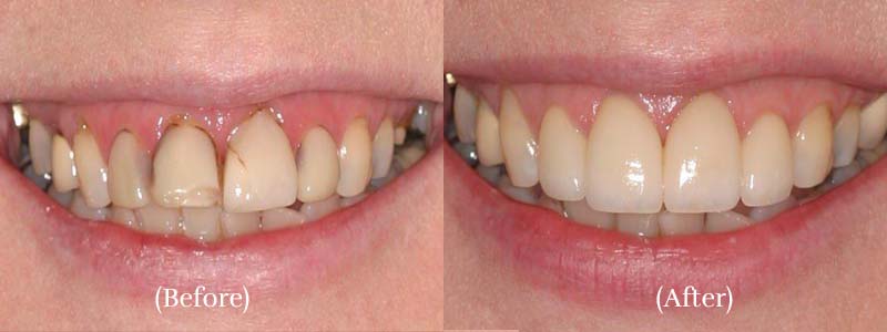 Veneers & laser tissue contouring closed image