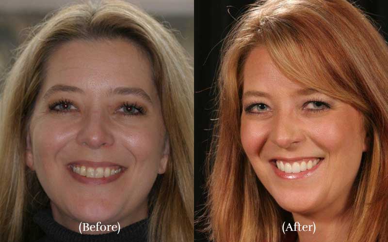 Veneers & contouring