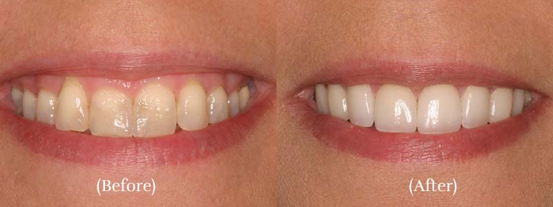 Before - after veneers & soft tissue laser contouring