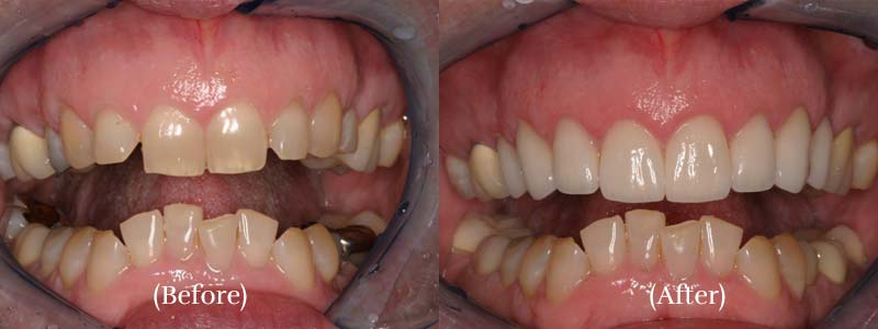 Upper porcelain veneers teeth