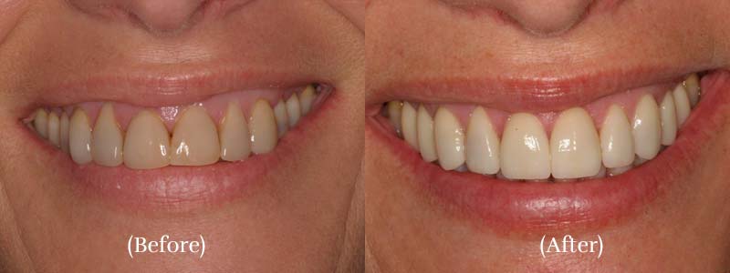 Veneers and special whitening