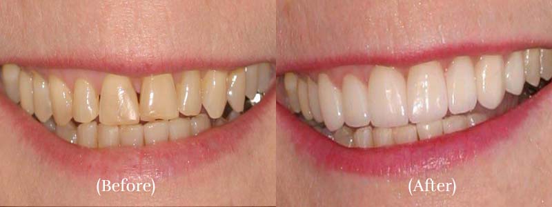 Dental veneers smiling teeth