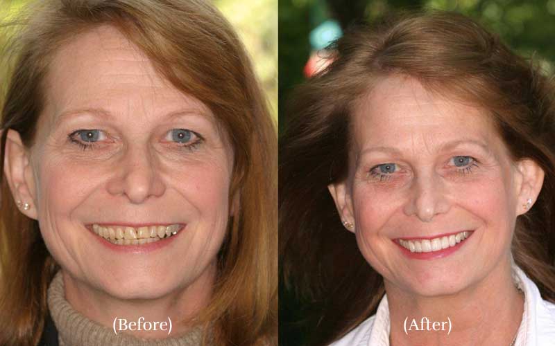 Dental veneers smiling