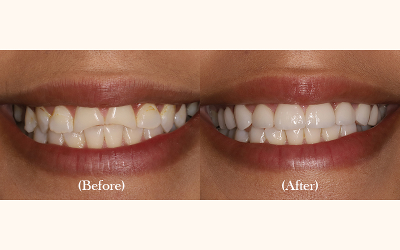 Porcelain Veneers Before & After