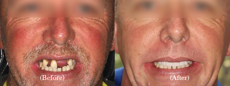 Upper Full Arch Implant-Supported Zirconium Bridge (Permanent, Screw-Retained)