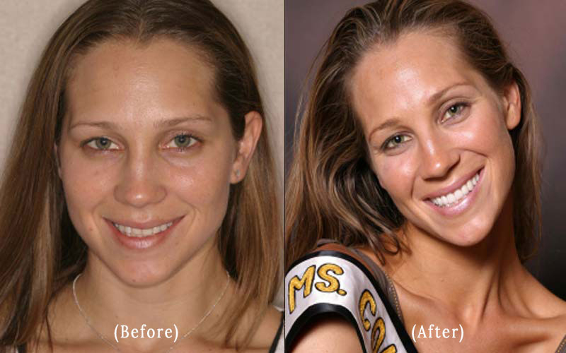 Pageant Lady – Upper Smile Makeover with 10 Veneers to Correct Short, Worn Teeth