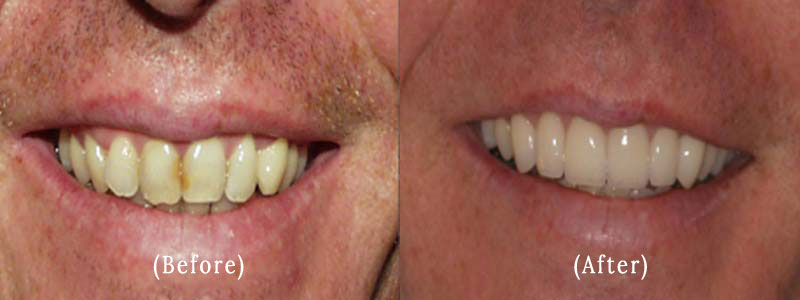 Upper 6 Veneers Before & After Results
