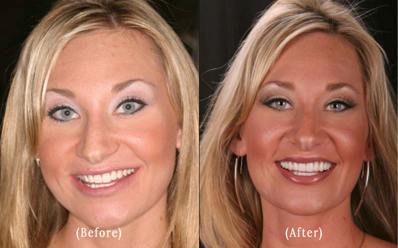 A beautiful smile upgrade with 10 porcelain veneers, creating a brighter, more even look