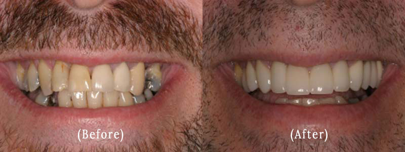 Full Upper Arch of Porcelain Restorations