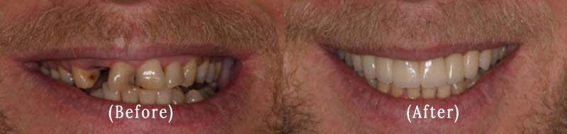 Full Upper Arch of Porcelain Teeth