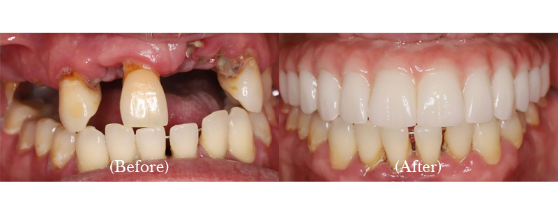 Upper Full Arch Implant-Supported Zirconium Bridge (Permanent, Screw-Retained)