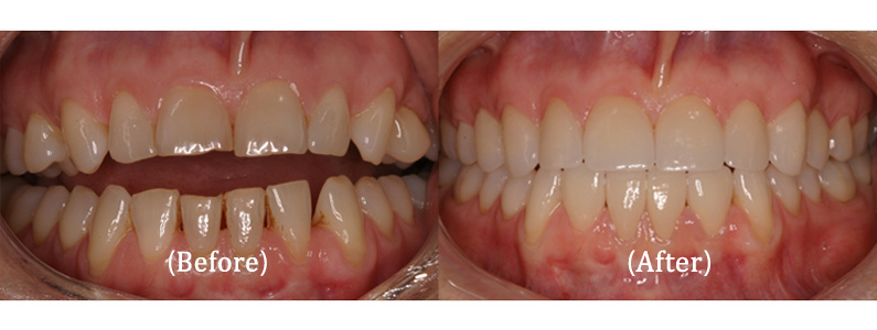 Full Upper and Lower Smile Makeover with Veneers