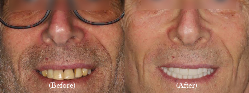 Full Implant-Supported Upper & Lower Zirconium Bridges