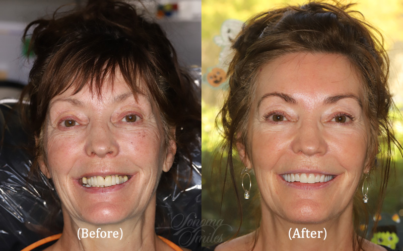 Full Upper Arch Reconstruction