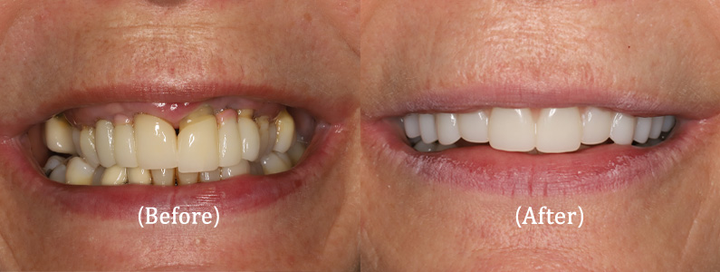 Full Upper Arch Reconstruction