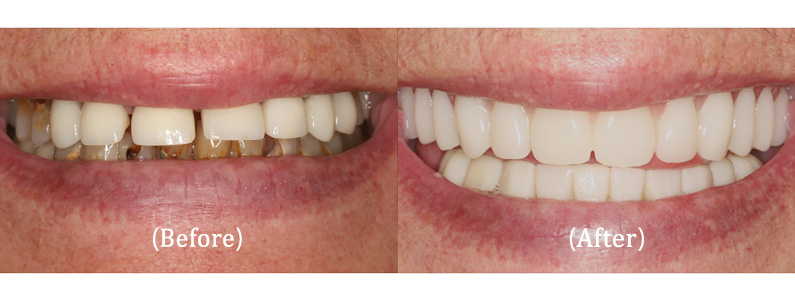 Full Upper Implant-Supported Teeth