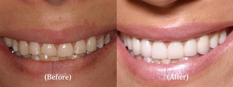 Pageant Lady – Upper Smile Makeover with 10 Veneers to Correct Short, Worn Teeth