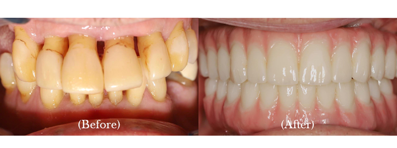 Full Implant-Supported Upper & Lower Zirconium Bridges