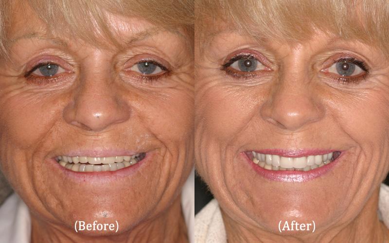 New Upper Fountain of Youth Cosmetic Denture
