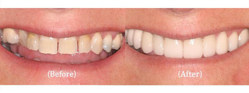 Porcelain Crowns (Full Mouth)