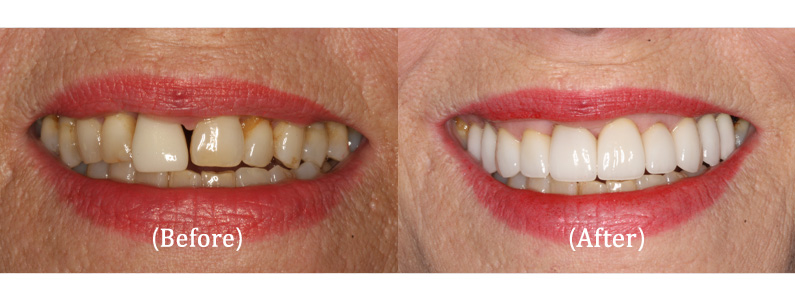 Upper 12 Porcelain Veneers