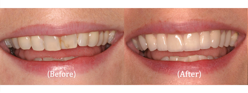 Upper 6 Porcelain Veneers