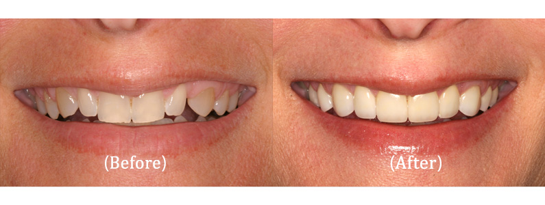 Upper 8 Porcelain Veneers