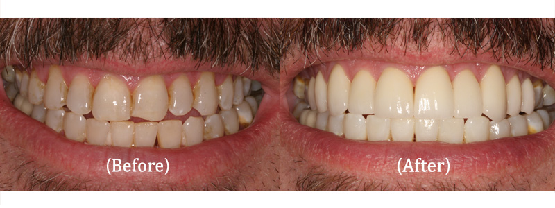 Upper and Lower Arch Reconstructions with Porcelain Veneers