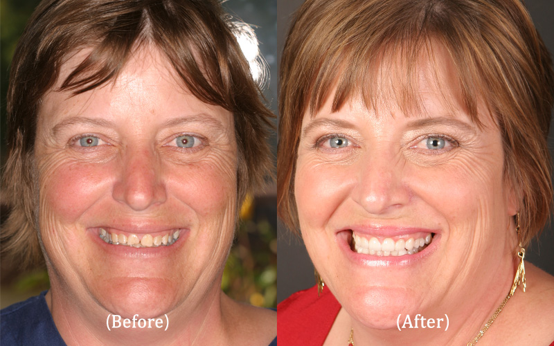Upper and Lower Full Mouth Reconstruction – Winner of the 'Give Back a Smile' Program