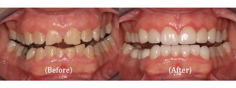 Upper and Lower Full Mouth Reconstruction – Winner of the 'Give Back a Smile' Program