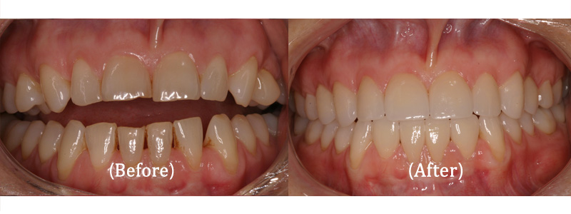 Upper and Lower Smile Makeover with Porcelain Veneers