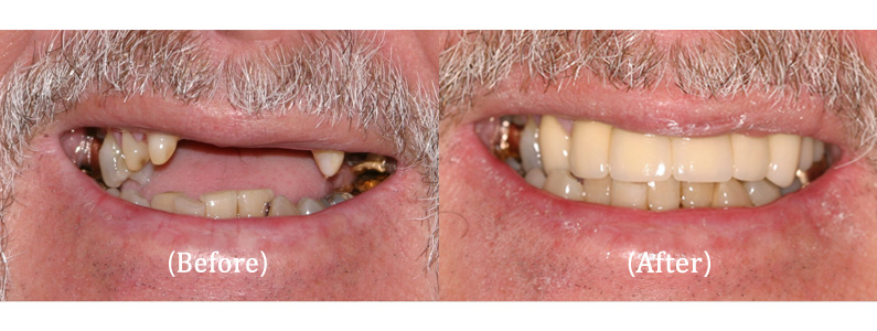 Upper Arch Porcelain Restoration