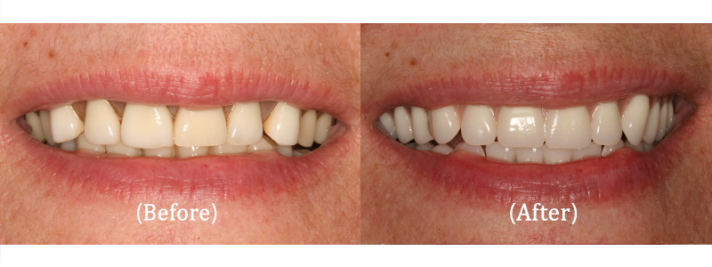 Upper Arch Reconstruction