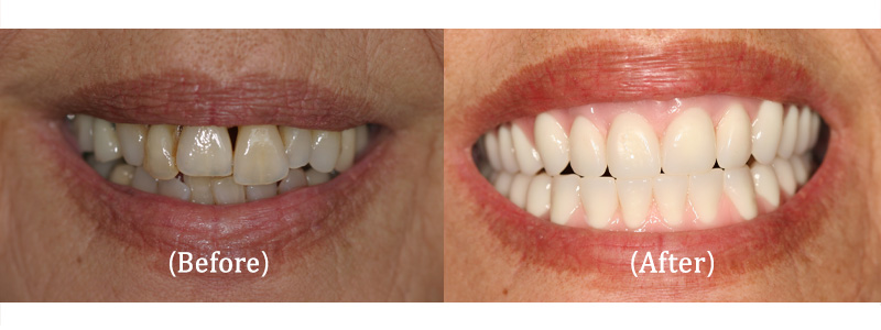 Upper Full Mouth Cosmetic Removable Teeth