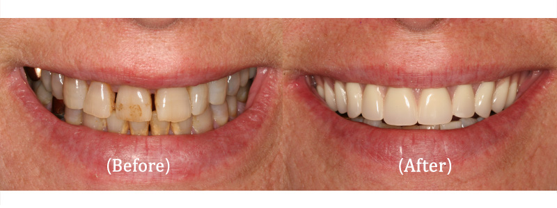Upper Implant-Supported Cosmetic Removable Teeth