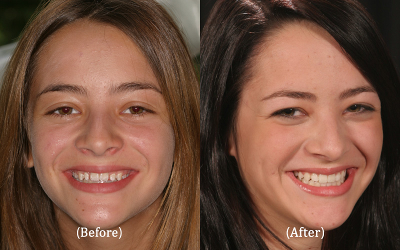 Upper Lateral Porcelain Veneers