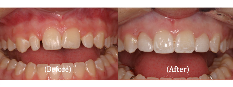Upper Lateral Porcelain Veneers
