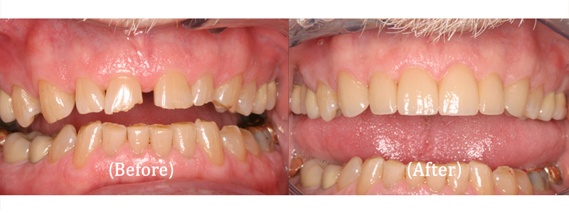 Upper Porcelain Crowns