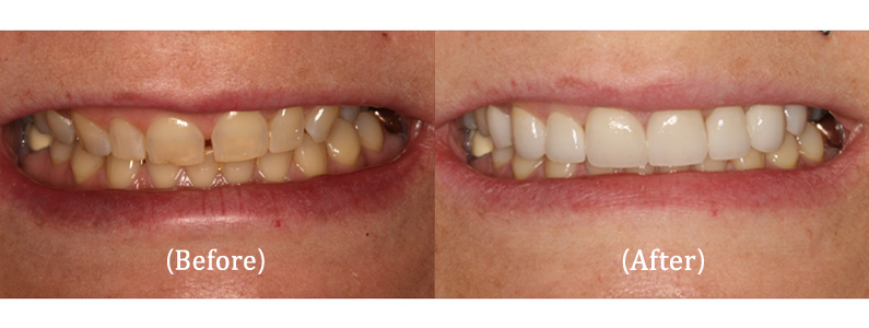 Upper Porcelain Veneers