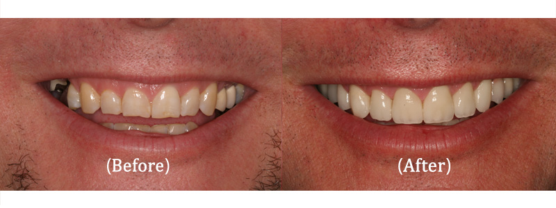 Upper Reconstruction with Porcelain and Implant-Supported Bridges