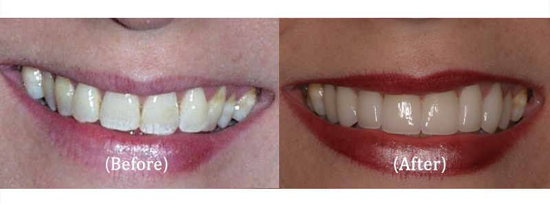 Upper Smile Makeover with Porcelain Veneers