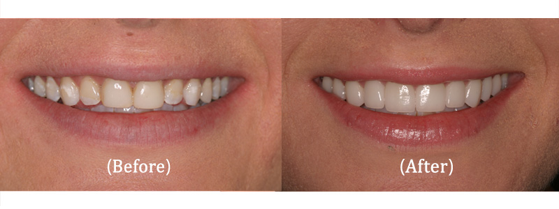 Upper Smile Makeover with Porcelain Veneers