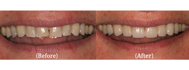 Upper 10 Prcelain Veneers Before & After Results