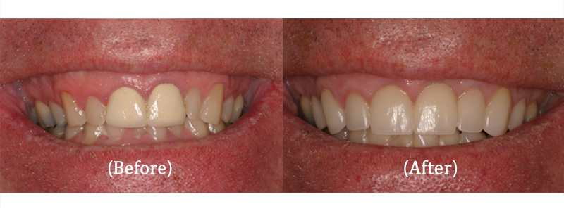 Upper Veneers